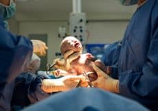 complicaties baby bevalling