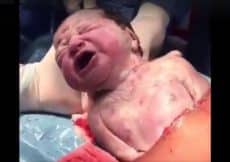 keizersnede bevalling foto