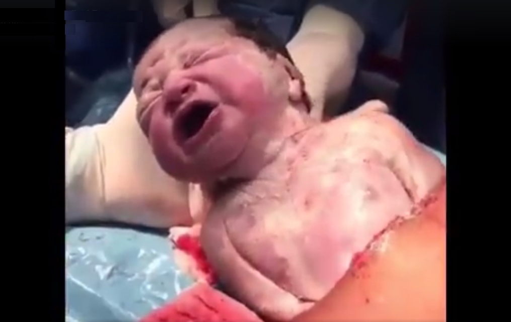 keizersnede bevalling foto