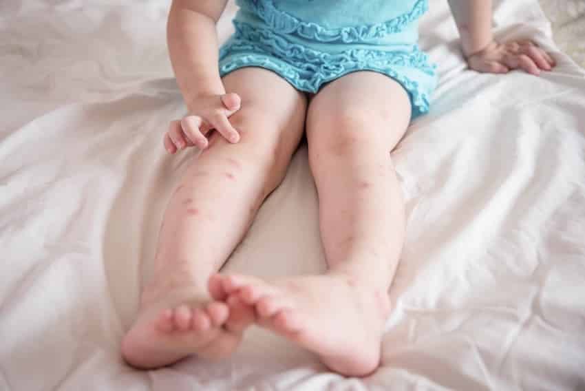 muggenbult baby behandelen