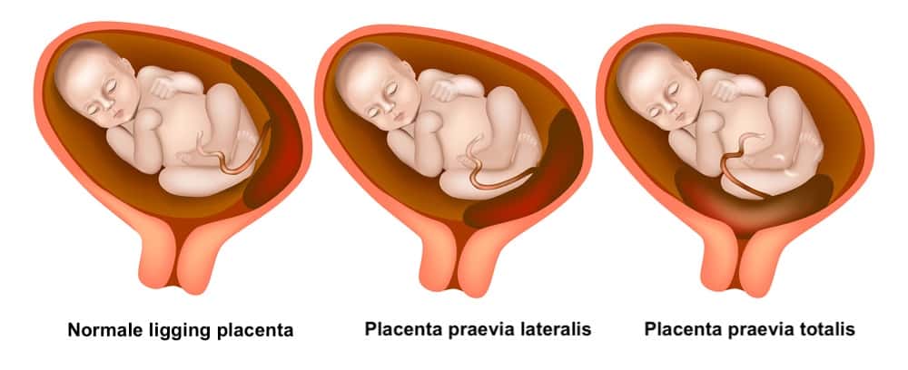 vormen voorliggende placenta praevia